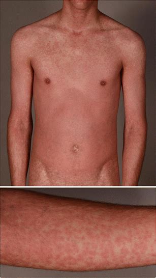 Clinical Pattern Of A Maculopapular Rash After The Intake Of