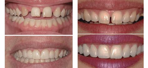 Cosmetic Dentistry Crooked Teeth Near Me Dental News Network