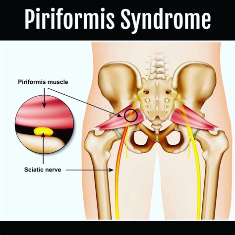 Piriformis syndrome has many causes, but muscle spasm plays an important role in the origin of sensitization due to local injury, trauma, or strain. Piriformis Syndrome Pain Massage in Cranford New Jersey ...
