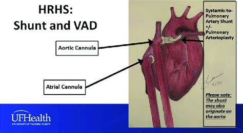 Configuration Of Palliation þ Vad For Hypoplastic Right Heart Syndrome