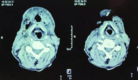 Contrast Enhanced Ct Scan Of Neck Revealing Necrotized Deep Soft Tissue
