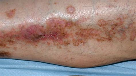 Diabetic Dermopathy Itchy Non Langerhansian Histiocytosis Psoriasis