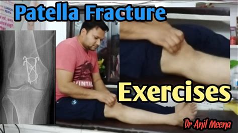 Patella Fracture Recovery Exercises Patella Fracture Exercises