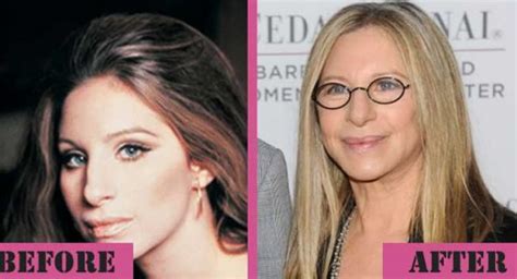 Barbra Streisand Plastic Surgery Facelift Nose Job Boob Job