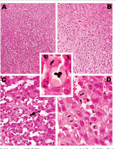 Figure 2 From Atypical Fibrous Histiocytoma And Atypical Fibroxanthoma
