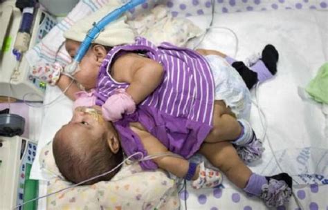 Conjoined Us Twins On Way To Separation Surgery Such Tv