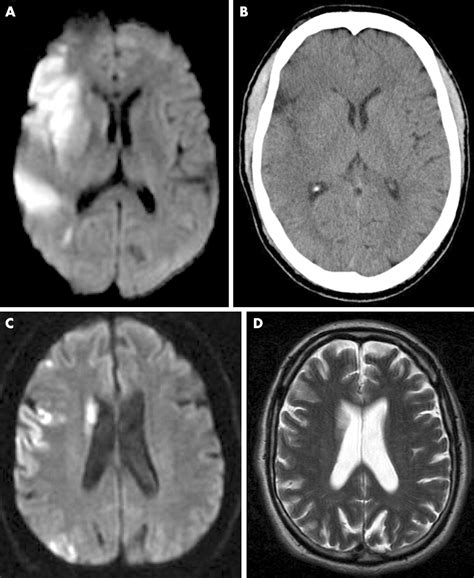 Imaging Of Acute Stroke And Transient Ischaemic Attack Journal Of