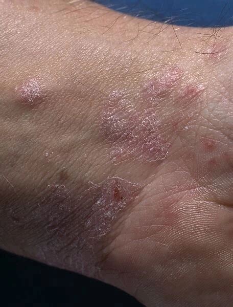 Psoriasis Lesions On The Skin Of A Mans Wrist Available As Framed