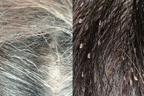 A Detailed Guide To Understanding And Treating Scalp Scabs