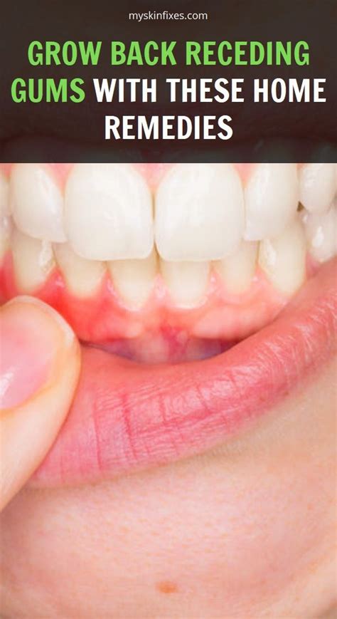 Grow Back Receding Gums With These Home Remedies Grow Back Receding