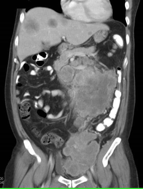 Lymphoma With Bulky Abdominal Nodes Stomach Case Studies Ctisus Ct