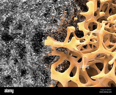 Computer Artwork Of A Bone Structure And Nanomaterial A Slice Of