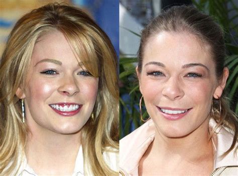 Celebrity Teeth Before And After Enhancements