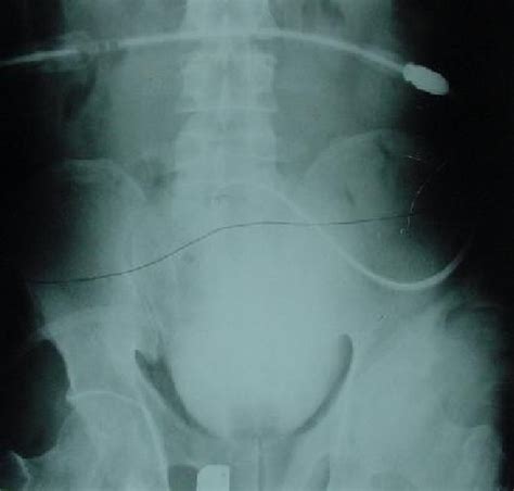 Instillation Of Contrast Through The Peritoneal Catheter Showing The