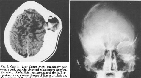 Figure 5 From Aneurysmal Bone Cyst With Fibrous Dysplasia Of The
