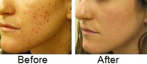 Side effects and other considerations. How to Fade Acne Scars Fast, Naturally, Diminish Acne ...