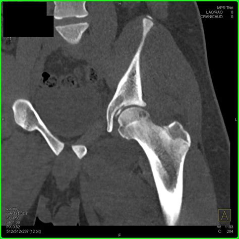 Intra Articular Fragment In The Left Hip Joint Following Left Hip