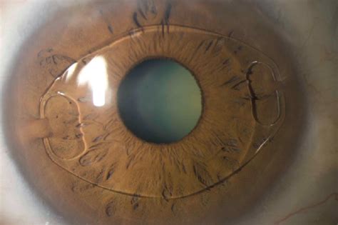 Implantable Contact Lenses Central Florida Eye Center P A