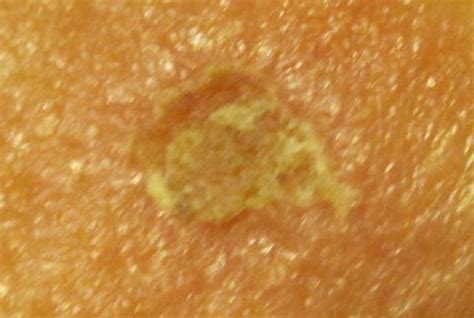 Hydrogen peroxide has great uses for skin, but i would be cautious if i have dry or sensitive skin as it might irritate and sting. Skin Cancer Forum - Hydrogen Peroxide 3%