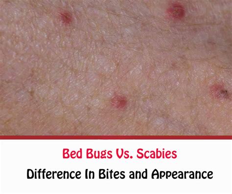 Scabies Bed Bugs
