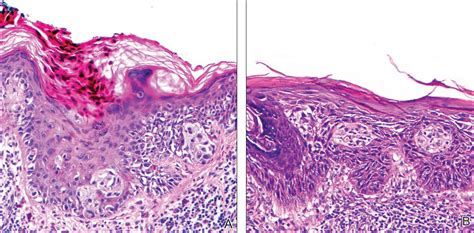 Actinic Keratosis As A Marker Of Field Cancerization In Excision