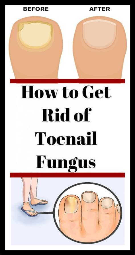 It releases its antifungal properties in the body, enhancing the body's ability to fight off the fungus. Coconut Oil To Get Rid Of Toenail Fungus (1) #healthcare # ...