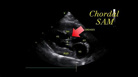 Systolic anterior motion (SAM) of the mitral chordae tendineae (chordal