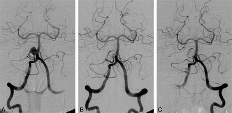 Fig 2 Management Of Anterior Inferior Cerebellar Artery Aneurysms