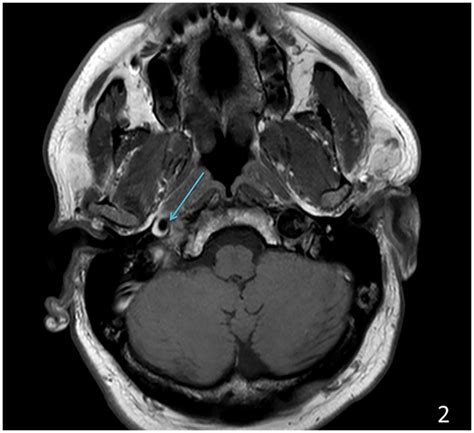 Mri Head And Neck With Contrast Showing T1 And T2 Intramural High