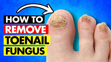 Removing Fungal Toenails Without Surgery