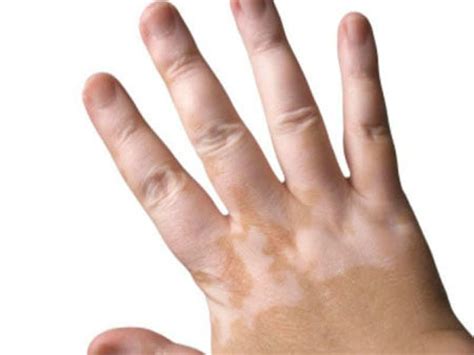 Ayurvedic Treatment For Vitiligo Vitiligo Permanent Treatment