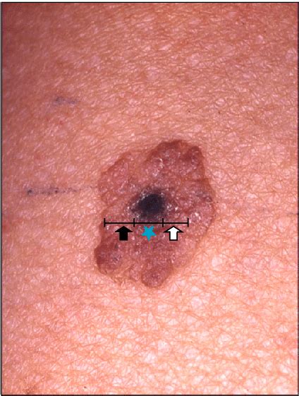 Targetoid Seborrheic Keratosis Central Black Plaque Surrounded By A