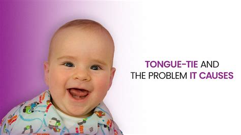 Tongue Tie And The Problems It Causes Dental World