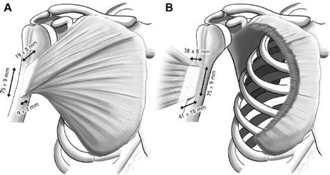 Tendon diagram of calf and knee. Schematic morphology of the pectoralis major (PM) tendon ...