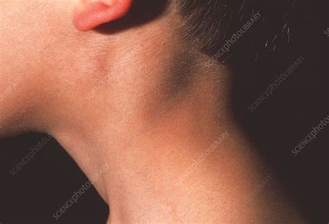 Swollen Neck Gland Stock Image M2000162 Science Photo Library