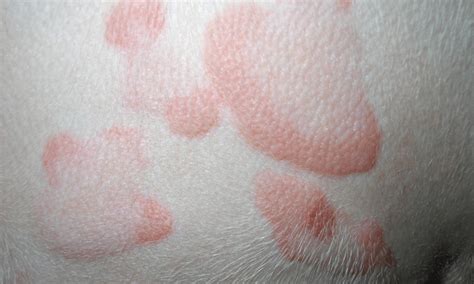 An Understanding Of Basic Skin Lesions And Their Patterns Of