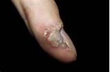 What is a foot (plantar) wart? Warts
