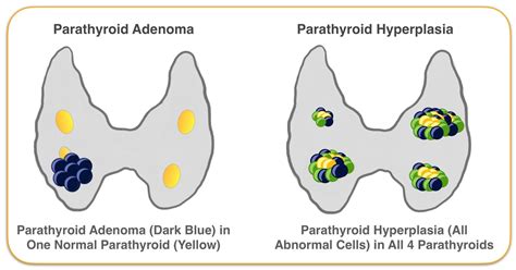 Difference Between Parathyroid Adenoma And Parathyroid Hyperplasia