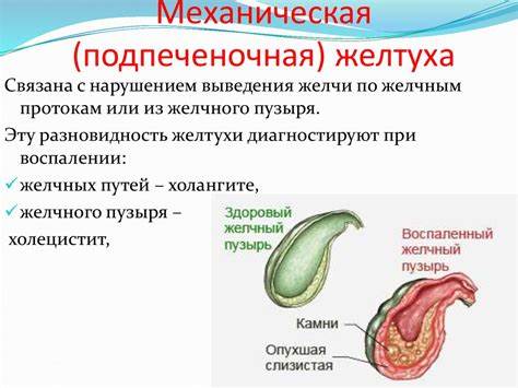 Диета при механическая желтуха Механическая желтуха - online presentation Механическая желтуха - online presentation Диета при механическая желтуха