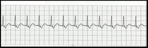 Float Nurse: Basic EKG Rhythm Test 06