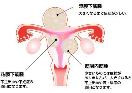 Nahrávejte, sdílejte a stahujte zdarma. 女性の腰痛の原因となる『子宮筋腫・子宮ポリープ』とは ...