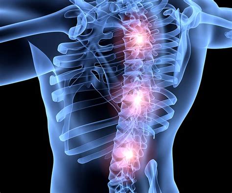 Polymyositis Degenerative Disorder Golden State Orthopedics Spine
