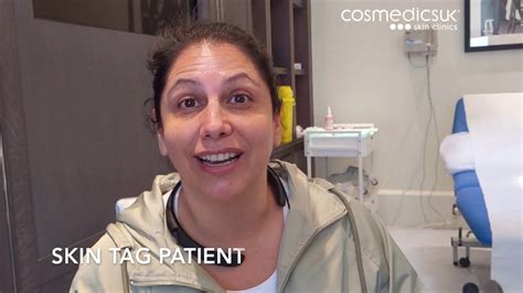 Pain Free Anal Skin Tag Removal Client Shares Her Experience At Cosmedics London Youtube