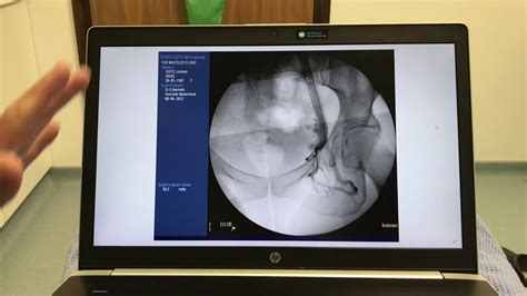 Pelvic Vein Embolization At The Whiteley Clinic Post Op Explanation By