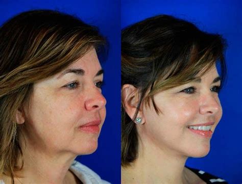 Before And After Tammy 52 Procedures Facelift Reflection Lift Face Lift Surgery