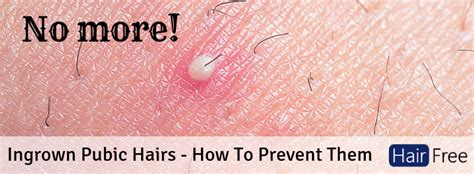 Ingrown Pubic Hairs What To Do And How To Prevent Them From Coming Back Hair Free Life