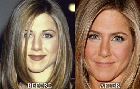 Jennifer Aniston Nose Job Or Rhinoplasty Before After Picture