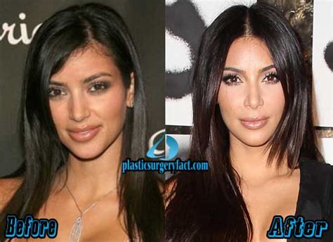 Kim Kardashian Nose Job Before And After