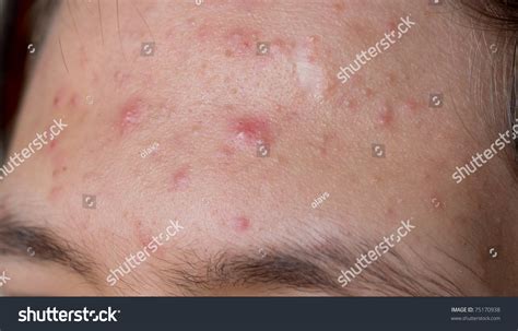 Male Acne On His Forehead Stock Photo 75170938 Shutterstock