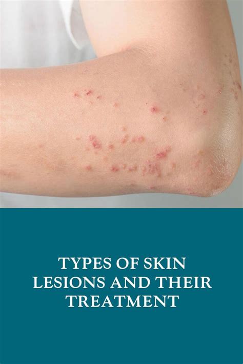 Skin Lesions Types And Treatment Dubai Cosmetic Surgery®